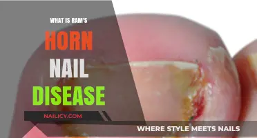 Understanding Ram's Horn Nail Disease: Causes, Symptoms, and Treatment Options