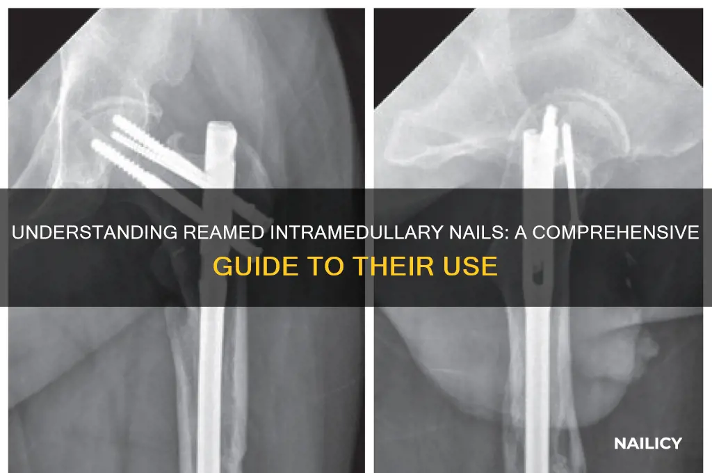 what is reamed intramedullary nail