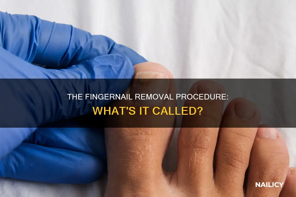 what is removal of finger nail called