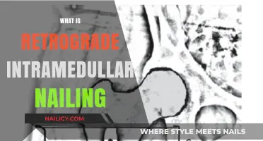 Understanding Retrograde Intramedullary Nailing: A Comprehensive Surgical Technique Overview