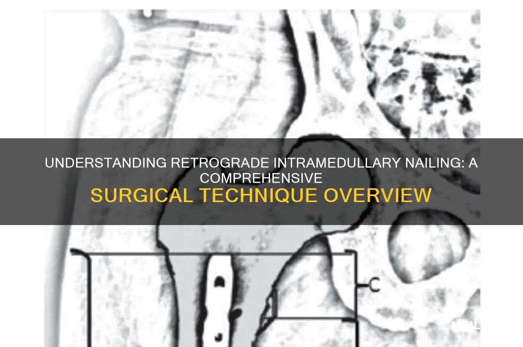 what is retrograde intramedullary nailing
