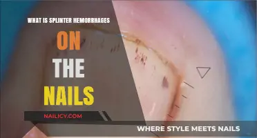 Understanding Splinter Hemorrhages: Nail Symptoms, Causes, and Treatment Options