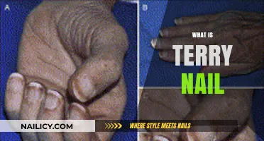 Understanding Terry's Nails: Causes, Symptoms, and Treatment Options Explained
