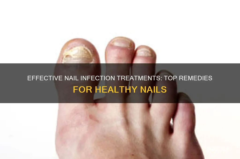 what is the best treatment for nail infection