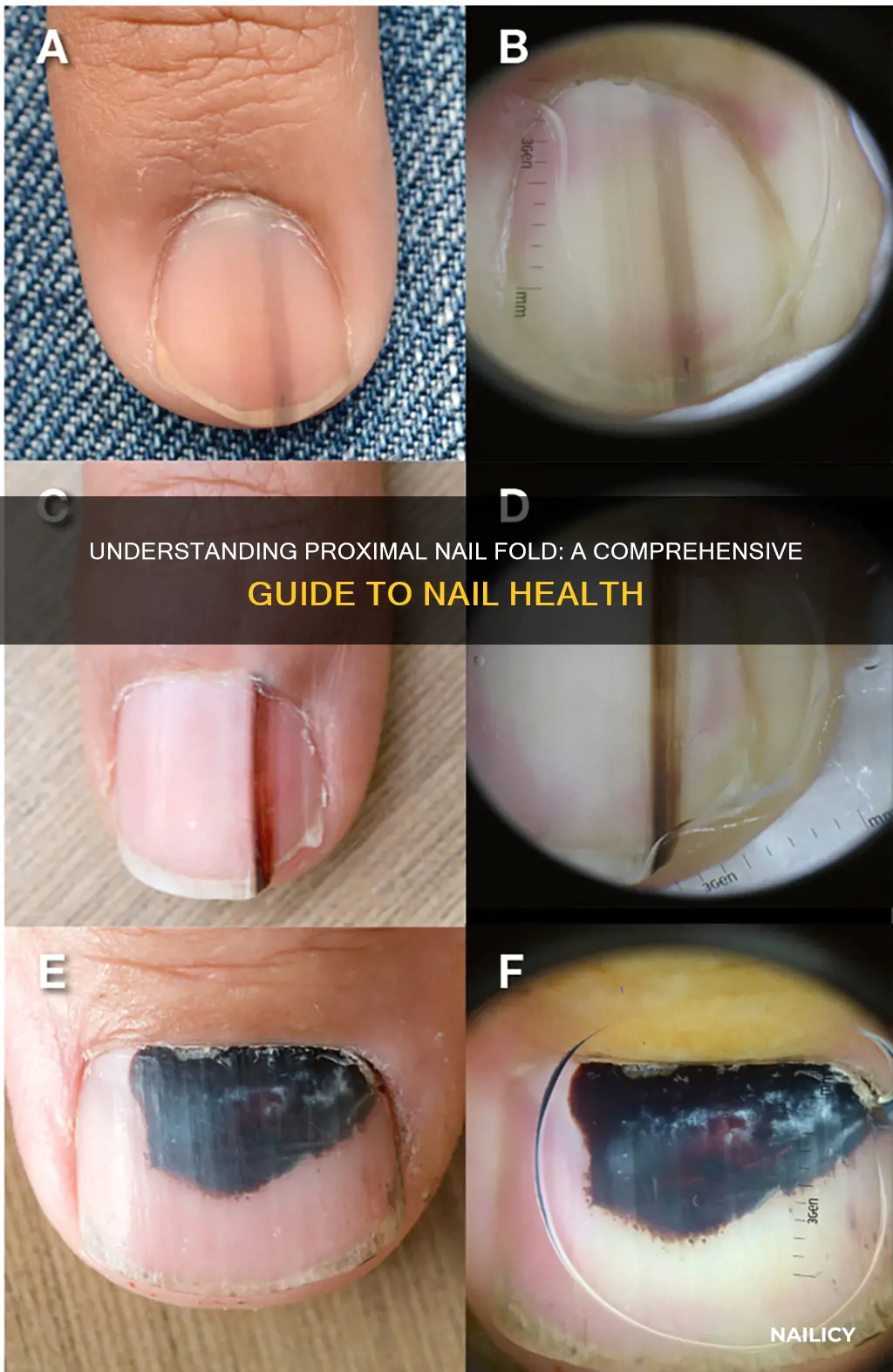 what is the meaning of proximal nail fold