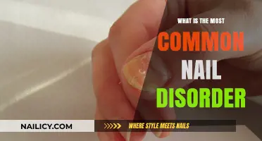 Understanding Onychomycosis: The Most Common Nail Disorder Explained
