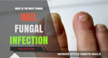 Understanding the Most Common Nail Fungal Infection: Causes and Treatments