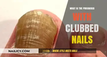 Clubbed Nails: Understanding the Prognosis and Underlying Health Conditions