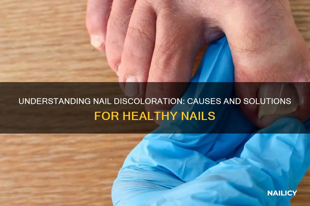 what is the reason for nail discoloration