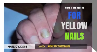 Why Are My Nails Yellow? Causes and Solutions Explained