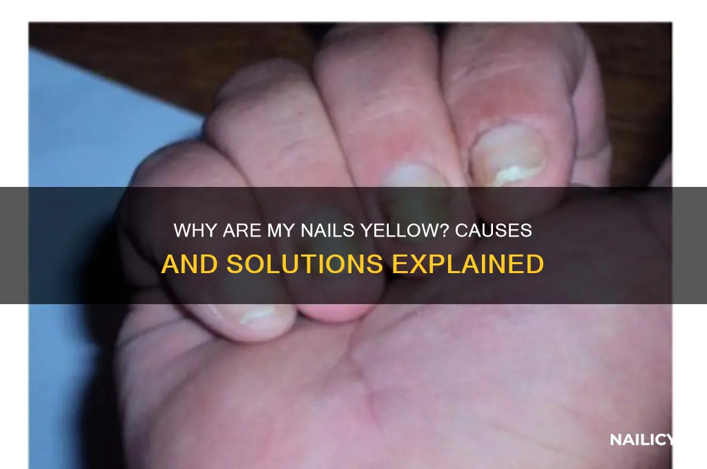 what is the reason for yellow nails