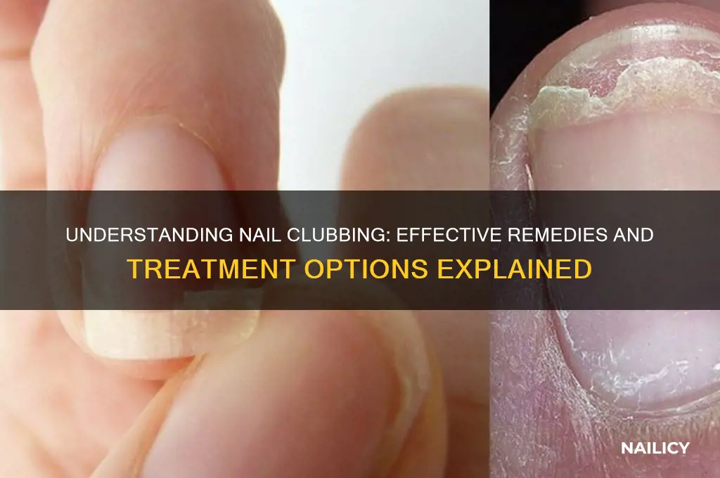what is the remedy for nail clubbing