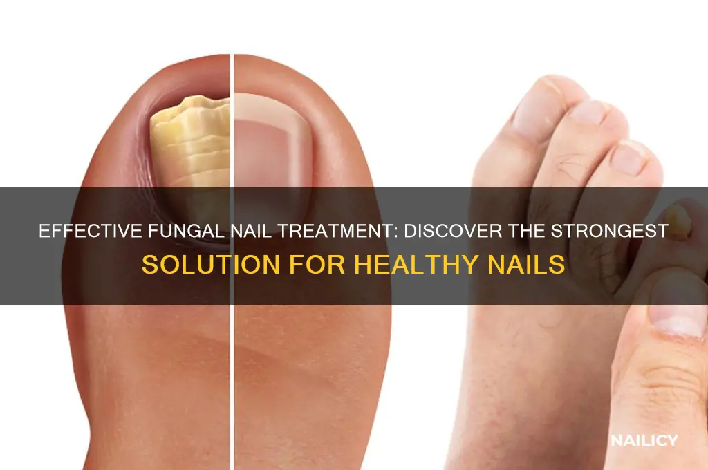 what is the strongest fungal nail treatment