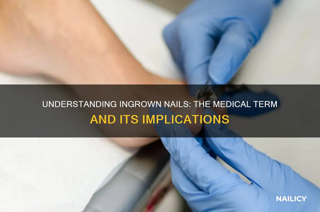 what is the term for ingrown nails