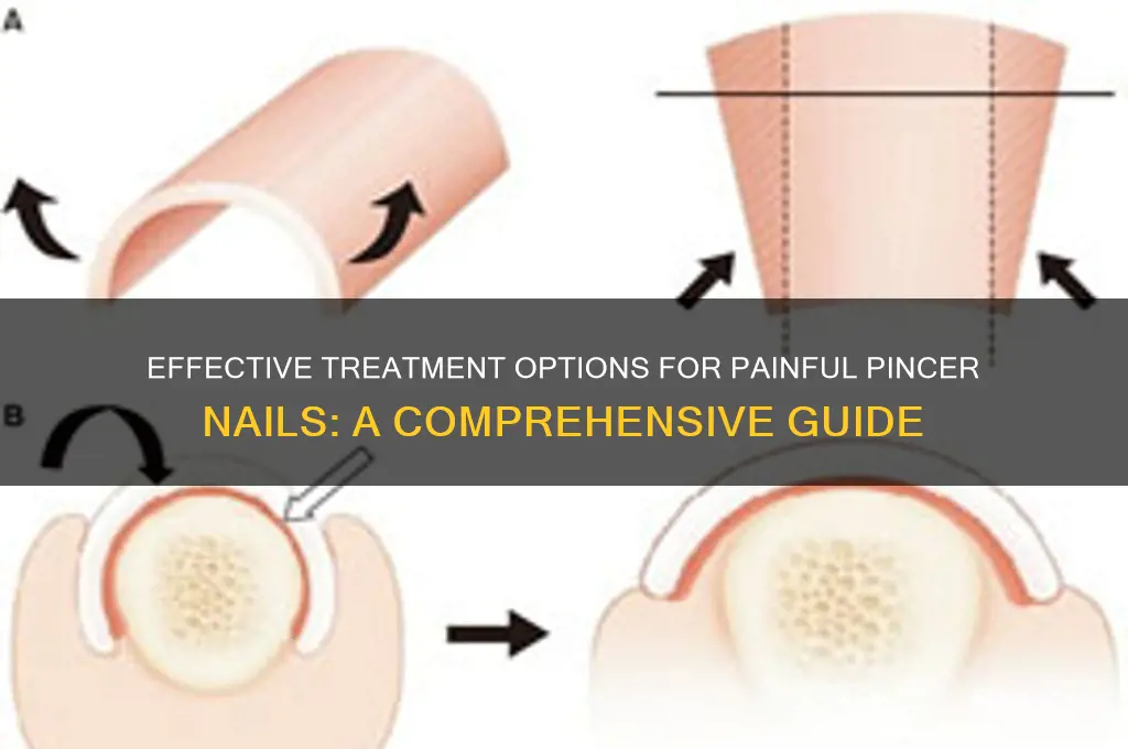 what is the treatment for pincer nails