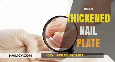 Understanding Thickened Nail Plate: Causes, Symptoms, and Treatment Options