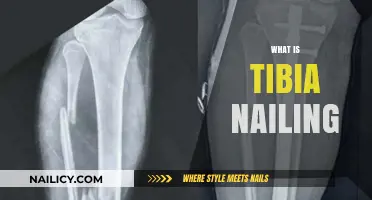 Understanding Tibia Nailing: A Comprehensive Guide to Surgical Fracture Repair