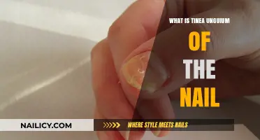 Understanding Tinea Unguium: Causes, Symptoms, and Treatment for Nail Fungus
