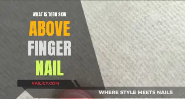 Torn Skin Above Fingernail: What's the Cause?