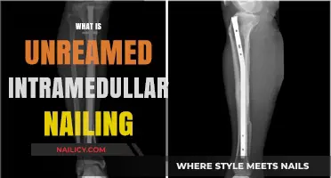 Understanding Unreamed Intramedullary Nailing: A Comprehensive Guide to Technique and Benefits