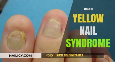 Understanding Yellow Nail Syndrome: Causes, Symptoms, and Treatment Options