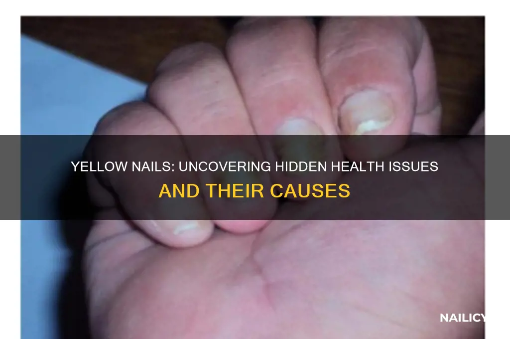 what is yellow nails a sign of