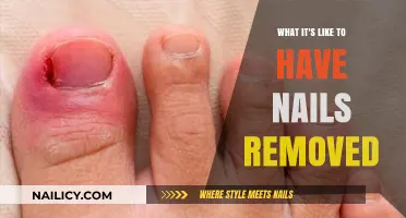 The Painful Experience of Nail Removal
