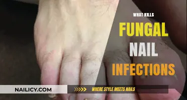 Effective Treatments to Eradicate Stubborn Fungal Nail Infections Permanently