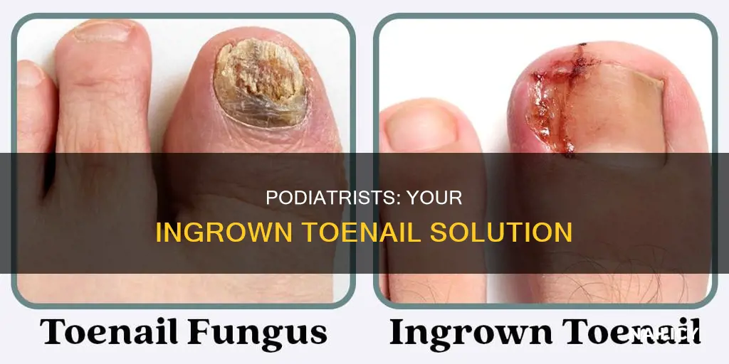 what kind of doctor cut your ingrown toe nails