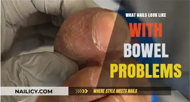 Nail Changes Linked to Bowel Issues: What to Look For