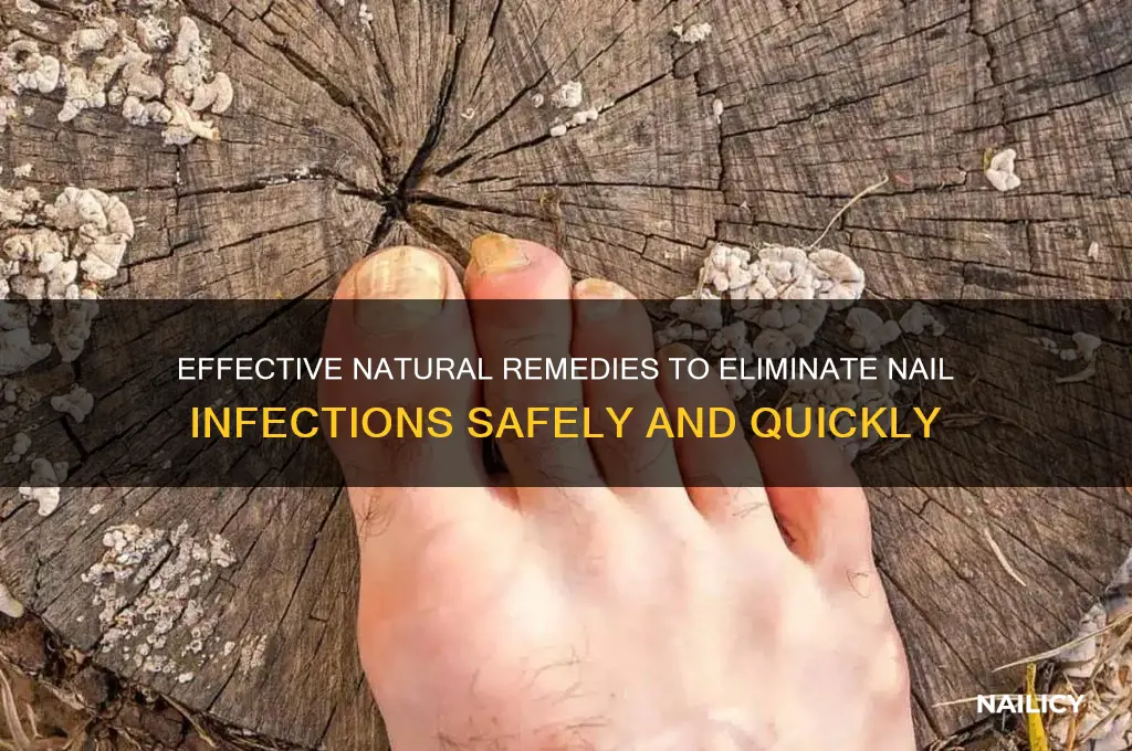 what naturally kills nail infection