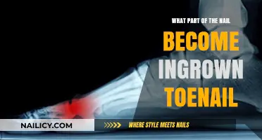 Understanding Ingrown Toenails: Which Nail Part Causes the Painful Condition?