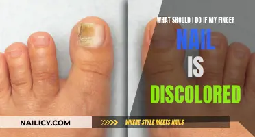 Nail Discoloration: Causes, Treatments, and When to See a Doctor