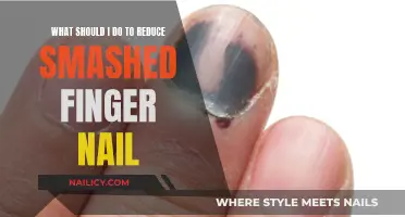 Heal Your Smashed Fingernail: Quick and Easy Home Remedies