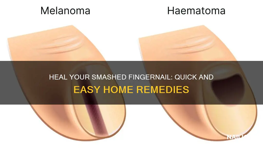 what should i do to reduce smashed finger nail