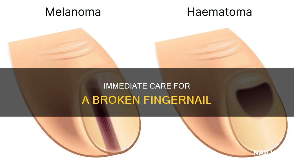 what should you do if you broke your finger nail