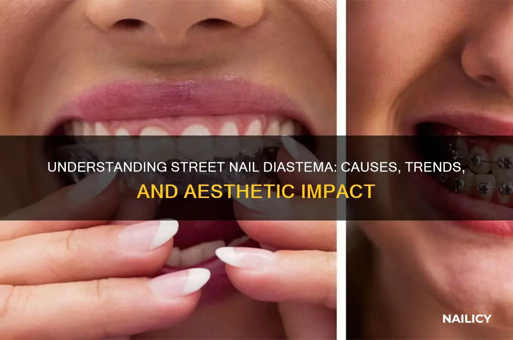 what street nail diastema
