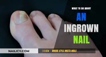 Effective Remedies and Prevention Tips for Painful Ingrown Nails