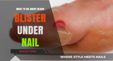 Blood Blister Under Nail: Effective Remedies and Prevention Tips