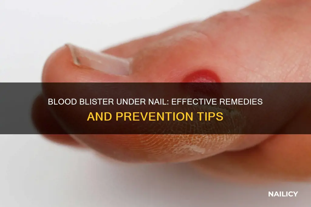 what to do about blood blister under nail