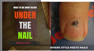 Blood Under the Nail: Quick Remedies and When to Seek Help