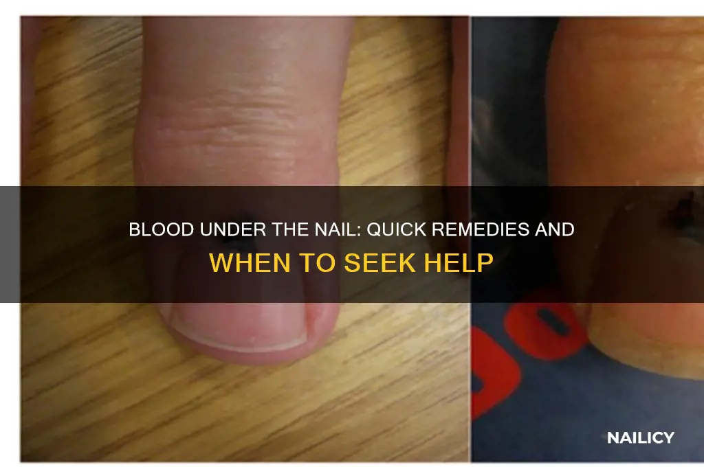 what to do about blood under the nail