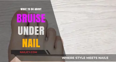 How to Treat and Heal a Painful Bruise Under Your Nail