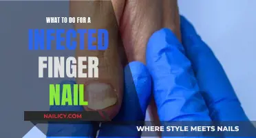 Treating an Infected Fingernail: Home Remedies and Medical Care