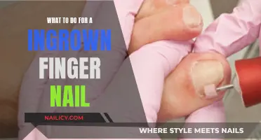 Treating an Ingrown Fingernail: Steps and Tips