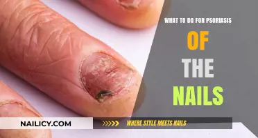 Effective Nail Psoriasis Treatments: Managing Symptoms and Restoring Nail Health