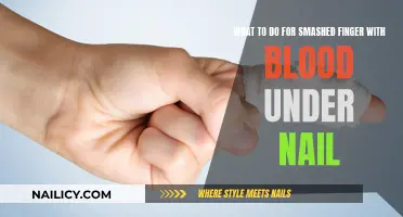 First Aid for a Smashed Fingernail and Bleeding Under Nail