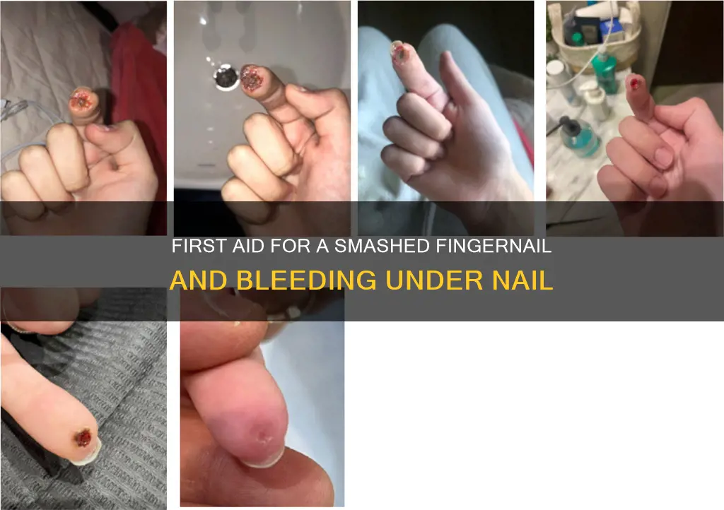 what to do for smashed finger with blood under nail