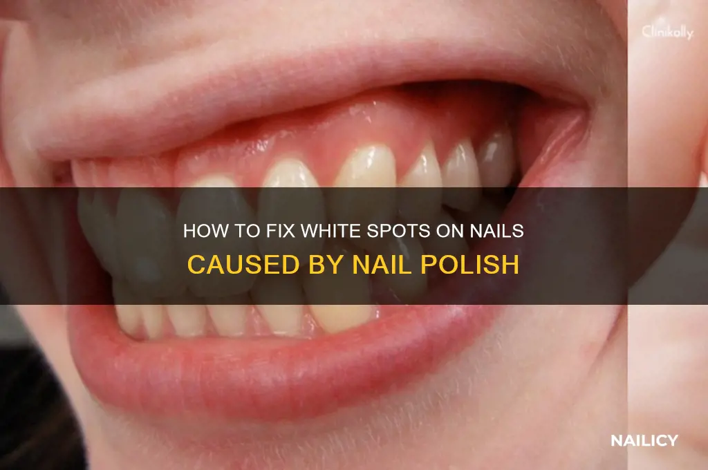 what to do for white spots on nails from polish