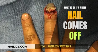 Nail Emergency: What to Do When a Finger Nail Comes Off